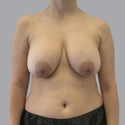 Breast Implant Removal Before & After Gallery - Patient 240068 - Image 1