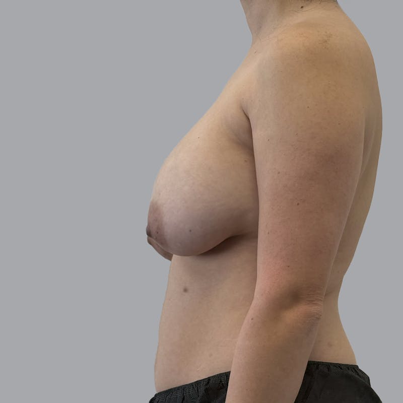 Breast Implant Removal Before & After Gallery - Patient 240068 - Image 5