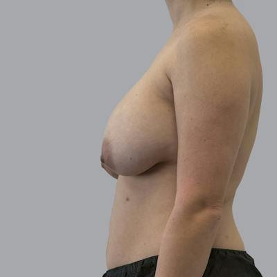 Breast Implant Removal Before & After Gallery - Patient 240068 - Image 5