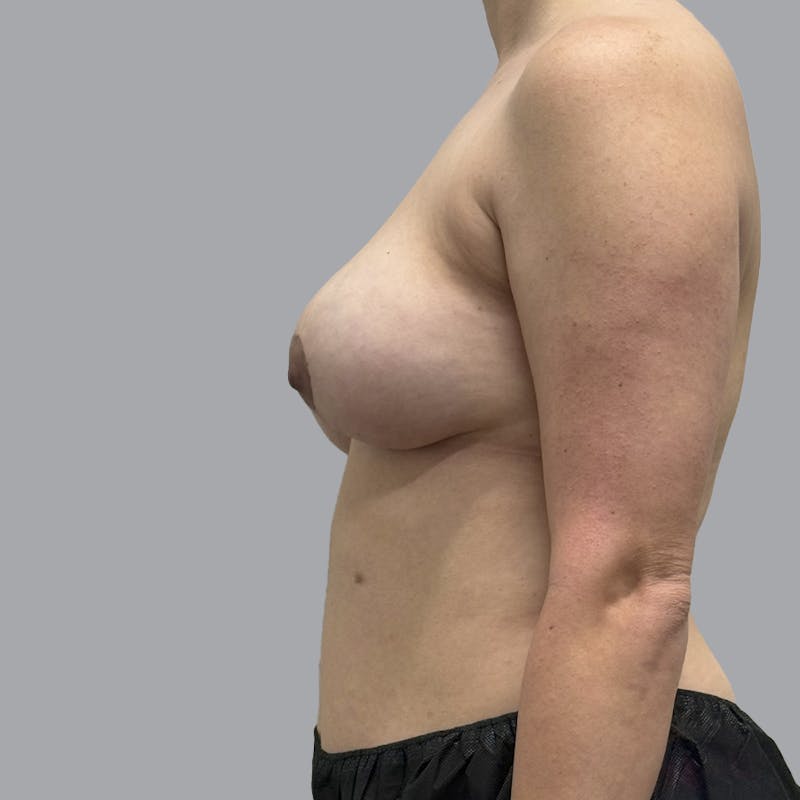 Breast Implant Removal Before & After Gallery - Patient 240068 - Image 6