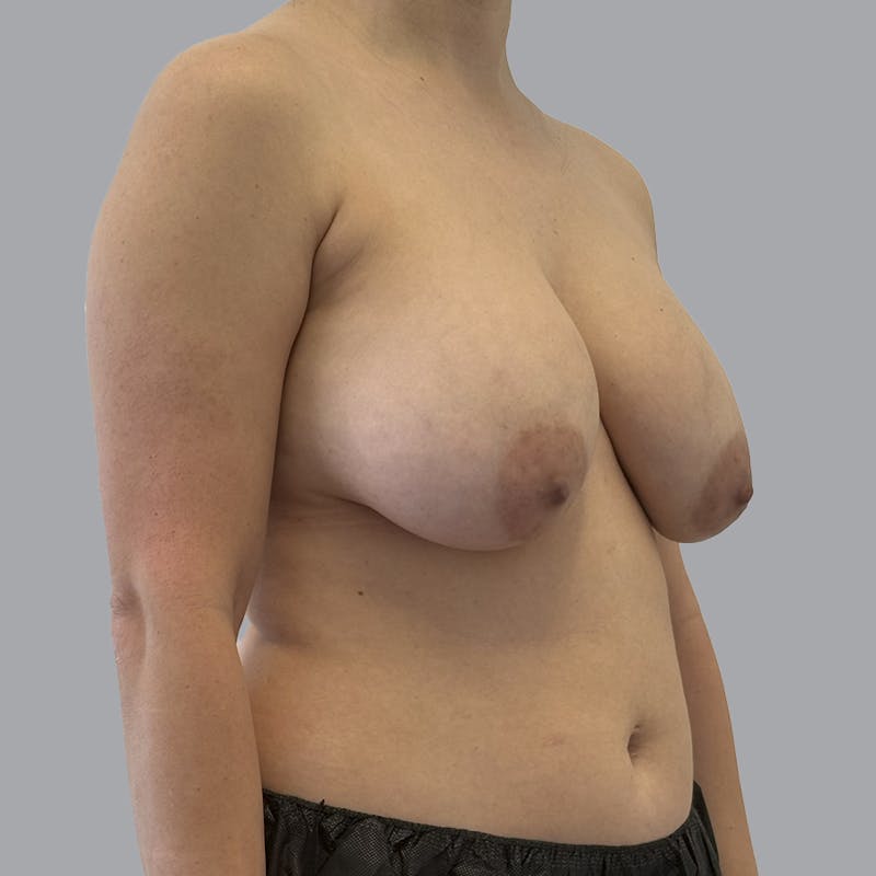 Breast Implant Removal Before & After Gallery - Patient 240068 - Image 3