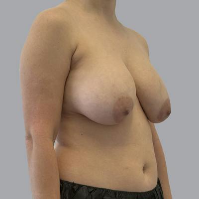 Breast Implant Removal Before & After Gallery - Patient 240068 - Image 3