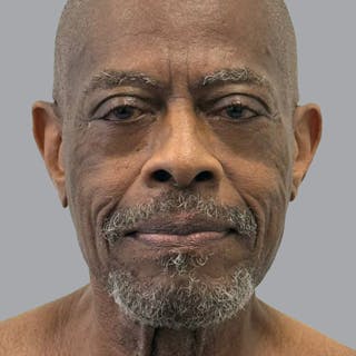Eyelid Surgery in Tampa Before & After Gallery - Patient 353485 - Image 2