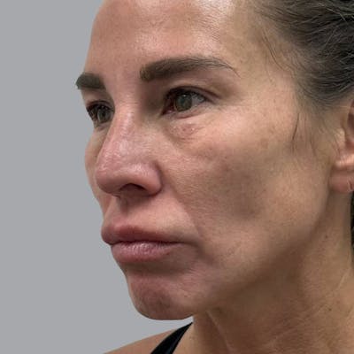 Blepharoplasty in Tampa Before & After Gallery - Patient 219189 - Image 3