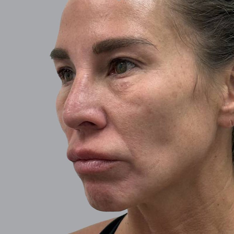 Blepharoplasty in Tampa Before & After Gallery - Patient 219189 - Image 3