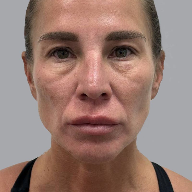 Blepharoplasty in Tampa Before & After Gallery - Patient 219189 - Image 1