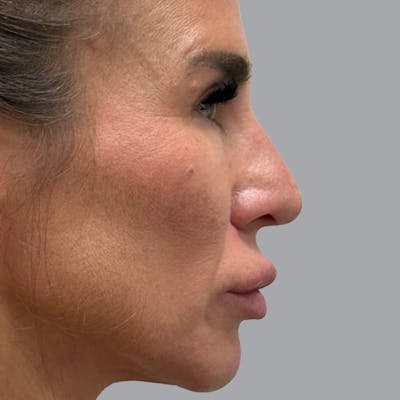 Blepharoplasty in Tampa Before & After Gallery - Patient 219189 - Image 6