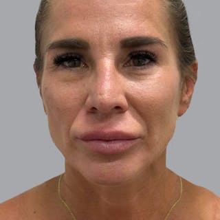 Blepharoplasty in Tampa Before & After Gallery - Patient 219189 - Image 2