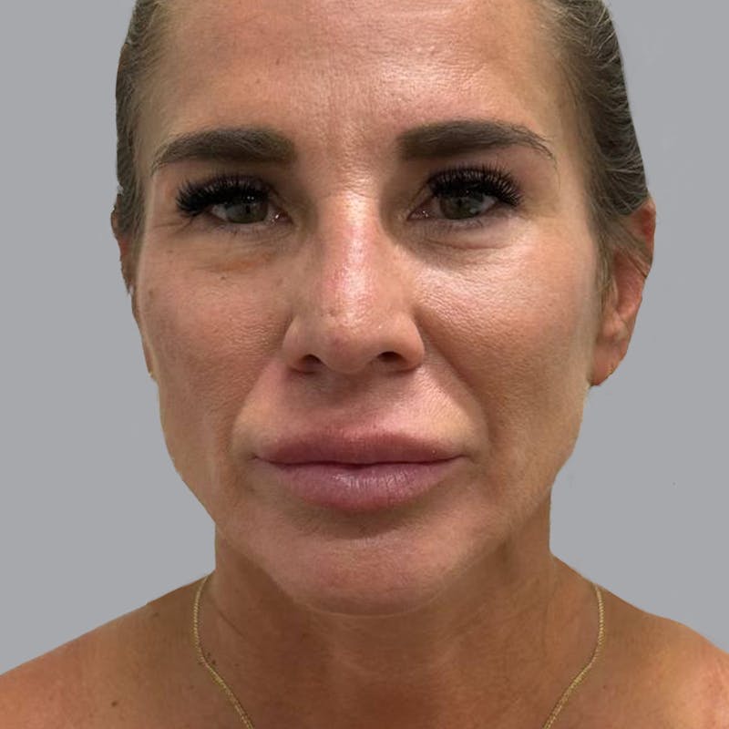 Blepharoplasty in Tampa Before & After Gallery - Patient 219189 - Image 2