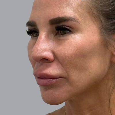 Blepharoplasty in Tampa Before & After Gallery - Patient 219189 - Image 4