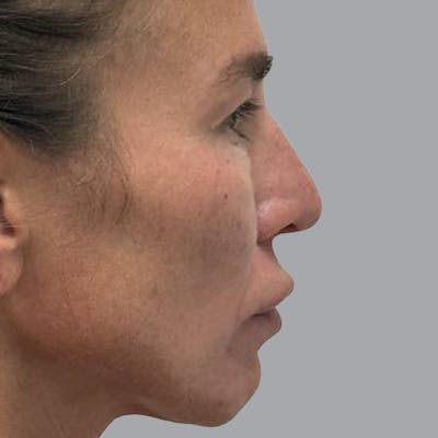 Blepharoplasty in Tampa Before & After Gallery - Patient 219189 - Image 5