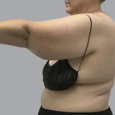 Lipedema Before & After Gallery - Patient 105815 - Image 5
