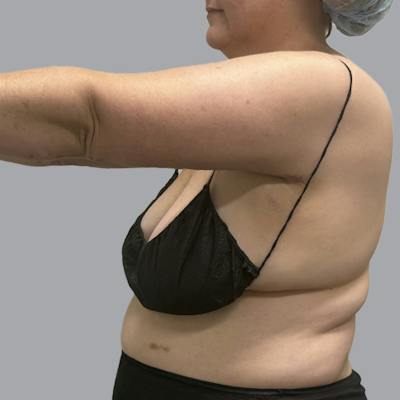 Lipedema Before & After Gallery - Patient 105815 - Image 6