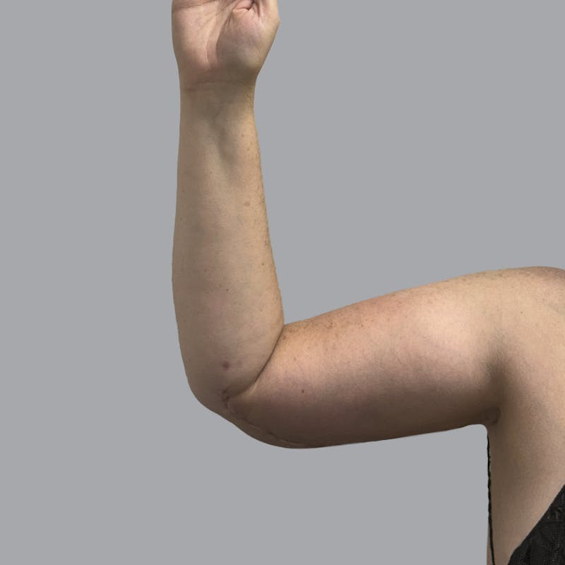 Lipedema Before & After Gallery - Patient 105815 - Image 4
