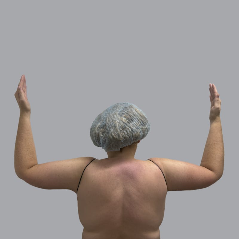 Lipedema Before & After Gallery - Patient 105815 - Image 2