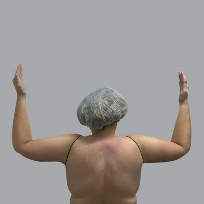 Lipedema Before & After Gallery - Patient 105815 - Image 2