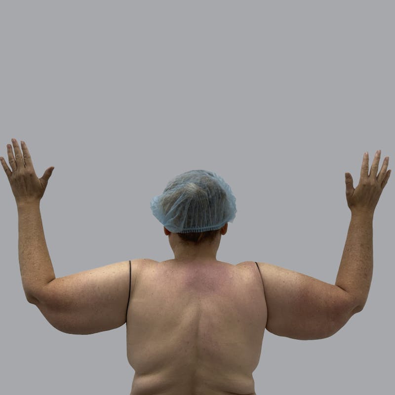 Lipedema Before & After Gallery - Patient 105815 - Image 1