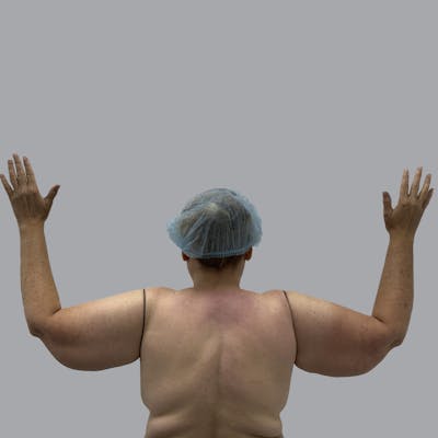 Lipedema Before & After Gallery - Patient 105815 - Image 1