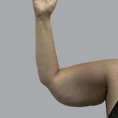Lipedema Before & After Gallery - Patient 105815 - Image 3
