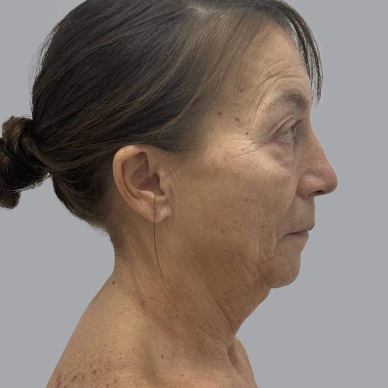 Facelift and Neck Lift Before & After Gallery - Patient 500734 - Image 5