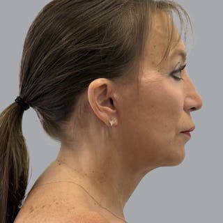 Blepharoplasty in Tampa Before & After Gallery - Patient 175057 - Image 6