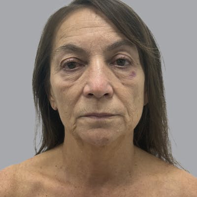 Blepharoplasty in Tampa Before & After Gallery - Patient 175057 - Image 1