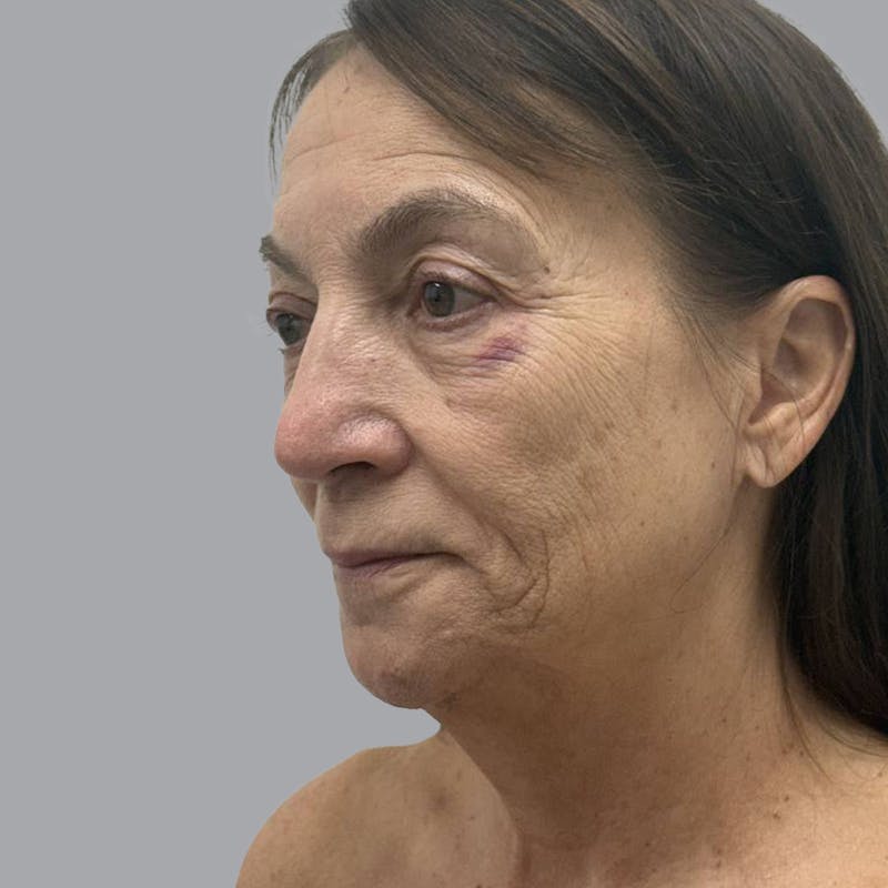 Facelift and Neck Lift Before & After Gallery - Patient 500734 - Image 3