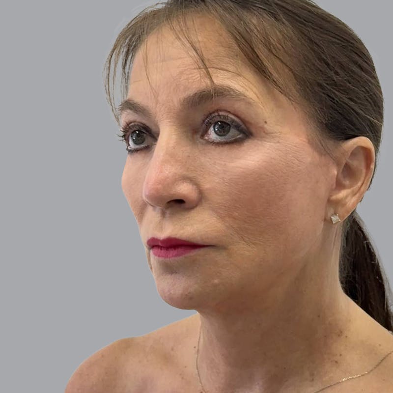 Facelift and Neck Lift Before & After Gallery - Patient 500734 - Image 4