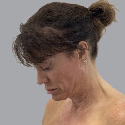 Facelift and Neck Lift Before & After Gallery - Patient 187106 - Image 3