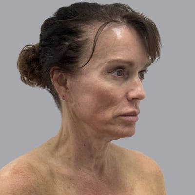 Facelift and Neck Lift Before & After Gallery - Patient 187106 - Image 5