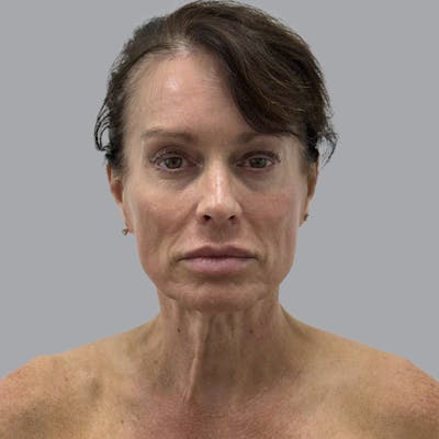Facelift and Neck Lift Before & After Gallery - Patient 187106 - Image 1