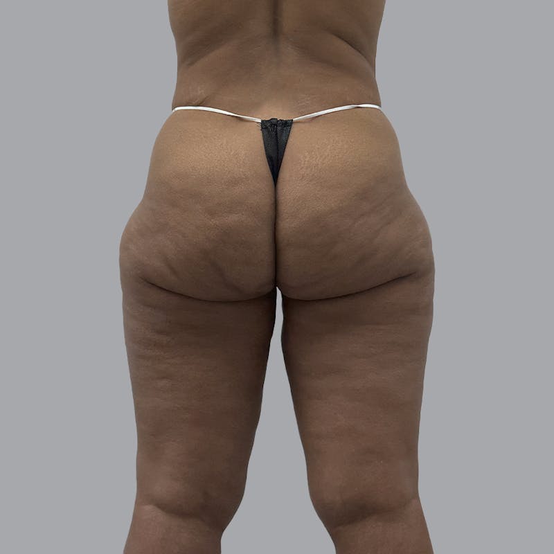 Brazilian Butt Lift and Hip Dip Before & After Gallery - Patient 342865 - Image 1