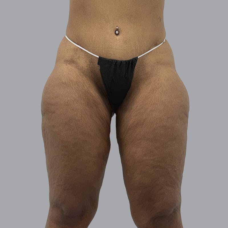 Brazilian Butt Lift and Hip Dip Before & After Gallery - Patient 342865 - Image 3