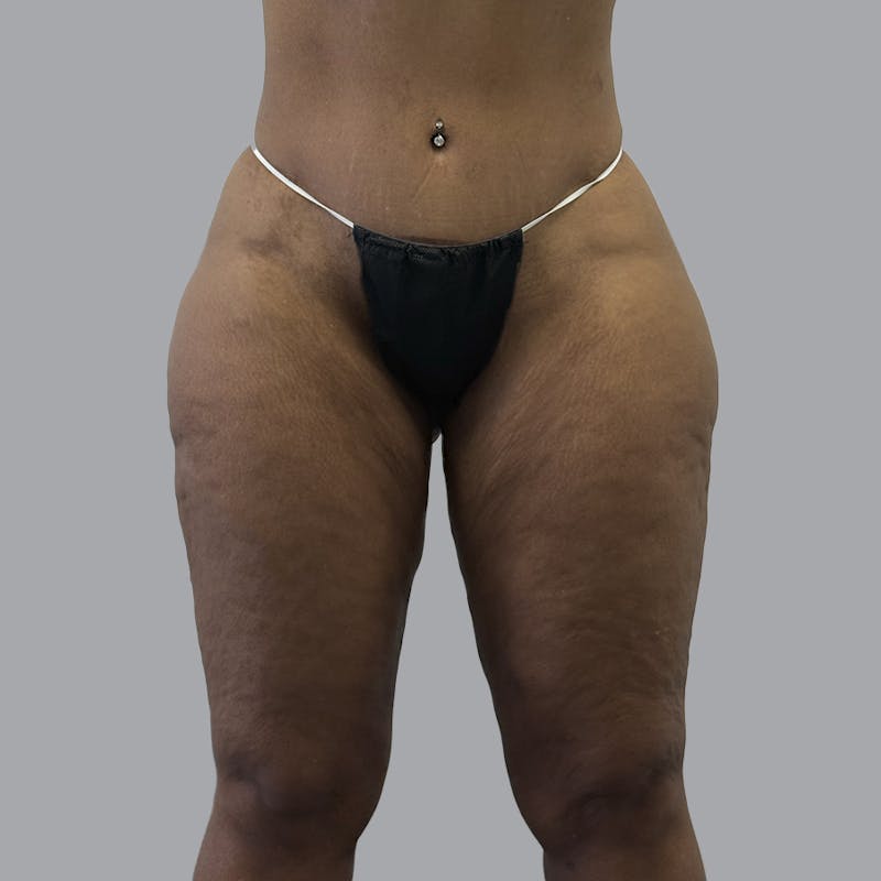 Brazilian Butt Lift and Hip Dip Before & After Gallery - Patient 342865 - Image 4