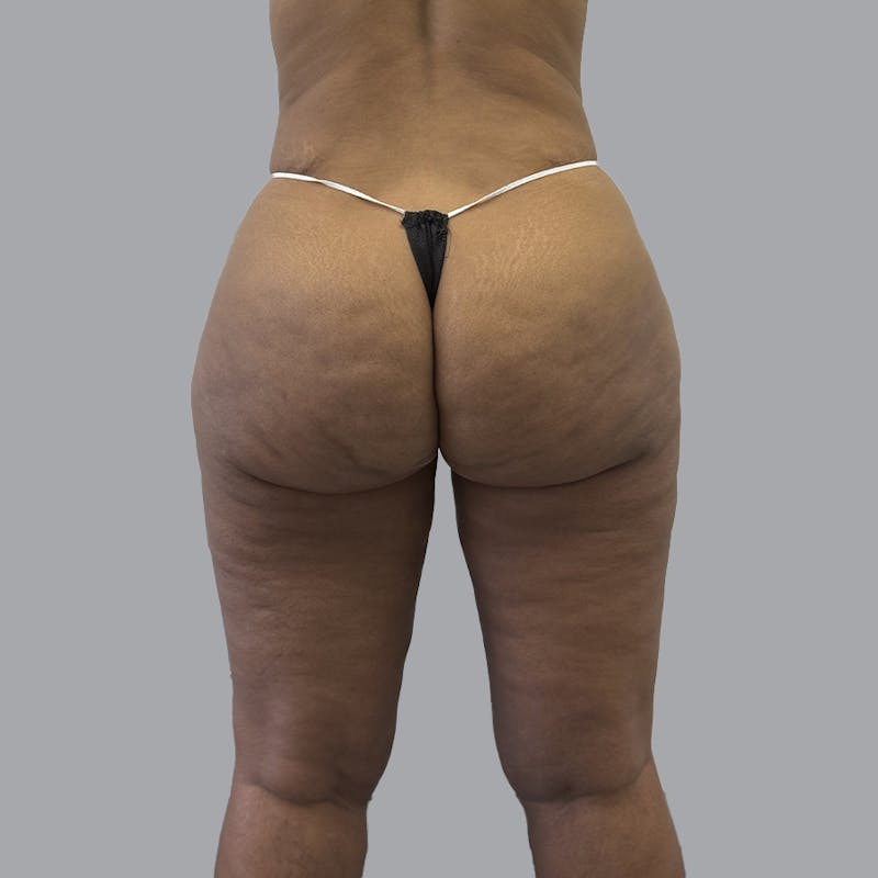 Brazilian Butt Lift and Hip Dip Before & After Gallery - Patient 342865 - Image 2