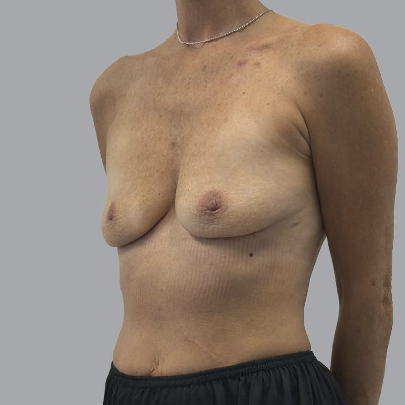 Breast Implant Removal Before & After Gallery - Patient 102378 - Image 4