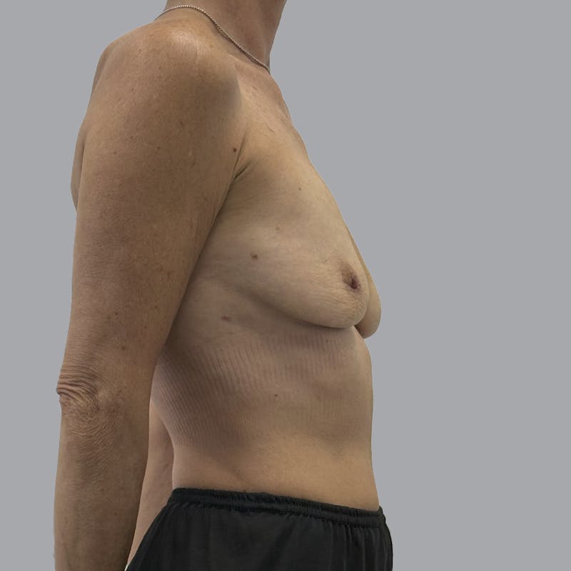 Breast Implant Removal Before & After Gallery - Patient 102378 - Image 6