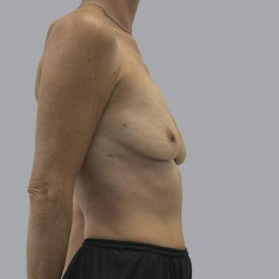 Breast Implant Removal Before & After Gallery - Patient 102378 - Image 6