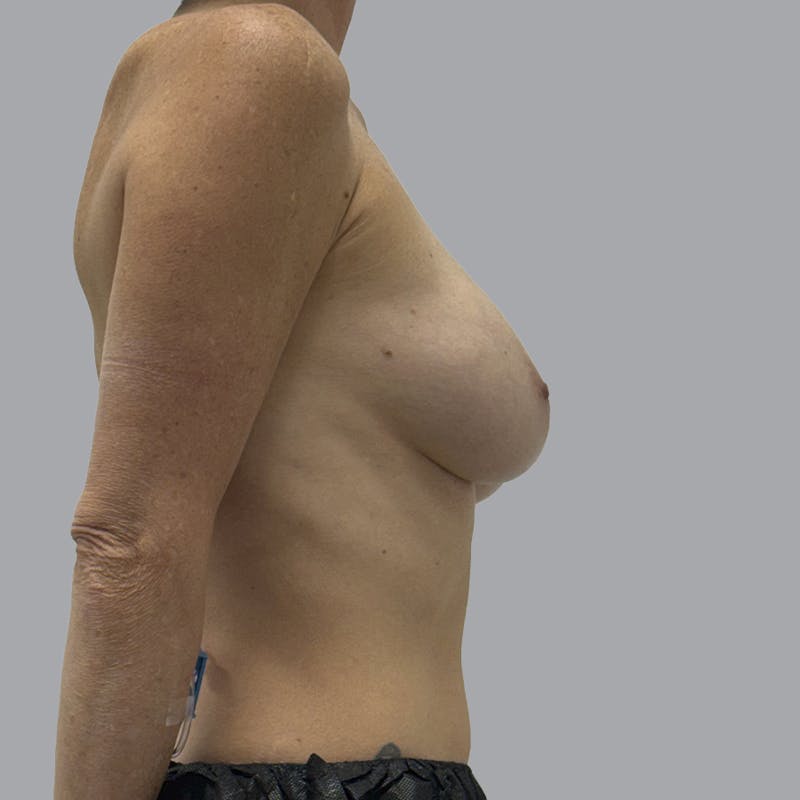 Breast Implant Removal Before & After Gallery - Patient 102378 - Image 5