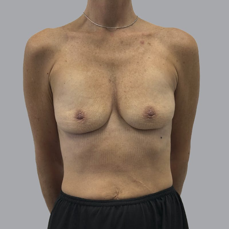 Breast Implant Removal Before & After Gallery - Patient 102378 - Image 2