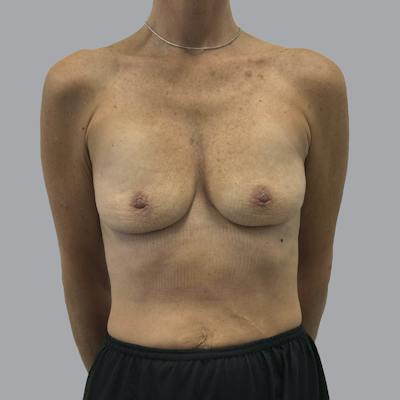 Breast Implant Removal Before & After Gallery - Patient 102378 - Image 2
