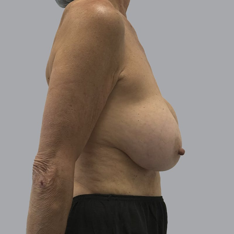 Breast Lift Before & After Gallery - Patient 331502 - Image 3