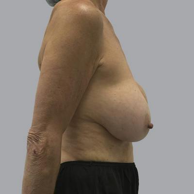 Breast Implant Removal Before & After Gallery - Patient 129403 - Image 3