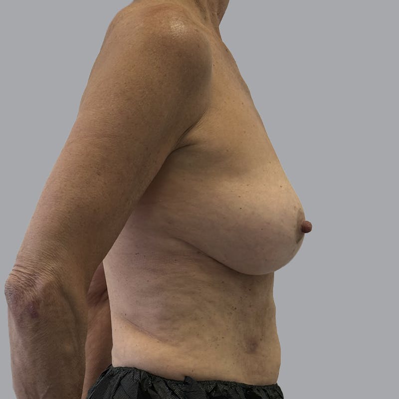 Breast Lift Before & After Gallery - Patient 331502 - Image 4