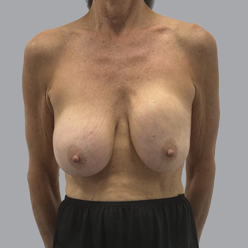 Breast Lift Before & After Gallery - Patient 331502 - Image 1