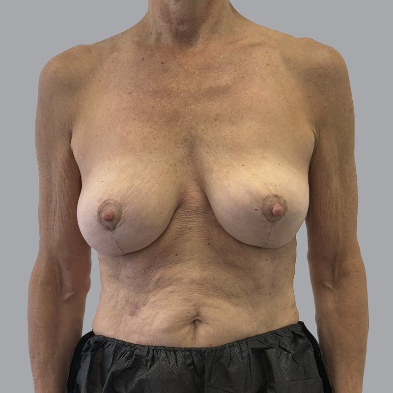 Breast Lift Before & After Gallery - Patient 331502 - Image 2
