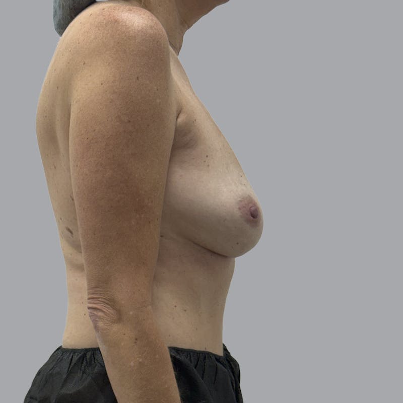 Breast Implant Removal Before & After Gallery - Patient 354931 - Image 6