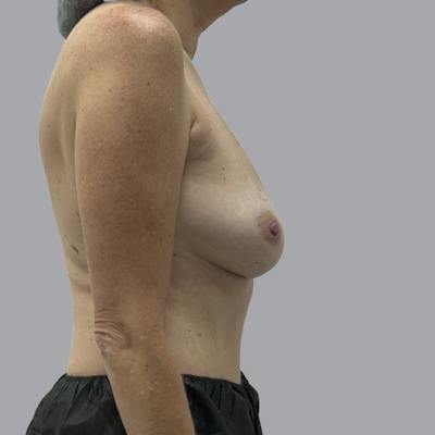 Breast Implant Removal Before & After Gallery - Patient 354931 - Image 6