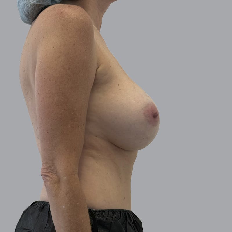 Breast Implant Removal Before & After Gallery - Patient 354931 - Image 5