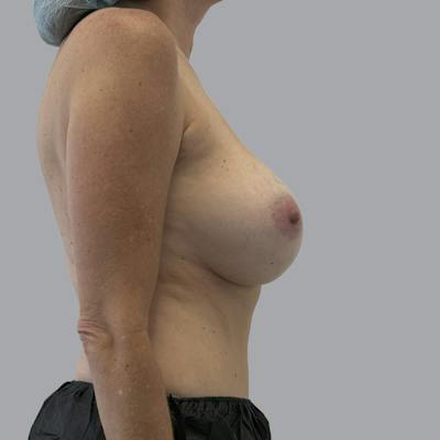 Breast Implant Removal Before & After Gallery - Patient 354931 - Image 5